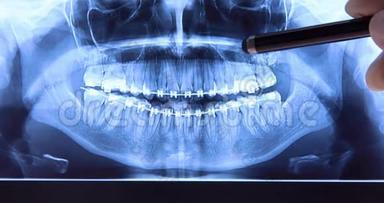 口腔医生用牙套分析牙片
