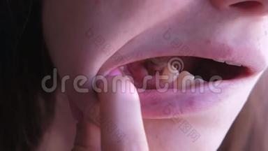 女孩显示粉红色的<strong>牙齿</strong>与<strong>龋齿</strong>和治愈使用间苯二酚-甲醛糊。