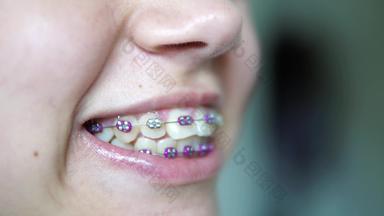 肖像青少年女孩显示牙科牙套一边视图电影景深