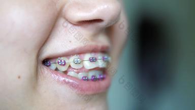 青少年舌头美丽的牙齿整形牙套治疗
