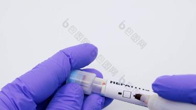 特写镜头微生物学家医疗工人手蓝色的外科手术手套标记血测试结果积极的肝炎肝炎积极的概念