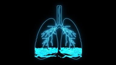 肺<strong>水肿</strong>条件引起的不正常的流体肺泡结果病人困难呼吸缺乏呼吸由于缺乏氧气
