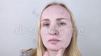 一个女人检查她脸上干燥的皮肤。 脱皮，粗化，不适，皮肤敏感.. 有皮肤病的病人