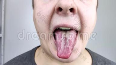舌头上有白豆腐。 医生或胃肠医生检查法力€™舌头。 病人口腔卫生或症状不佳