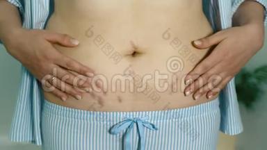 年轻女子在分娩后<strong>露出</strong>腹部。 出生后腹部有拉伸痕迹