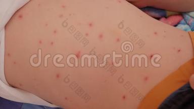 一位母亲检查患有水痘的孩子发炎的皮肤。