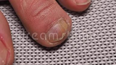 由真菌引起的指甲感染，如：由皮肤癣菌和酵母菌引起的真菌感染，以及伴随的抗菌作用