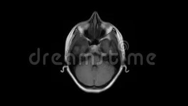 脑MRI，头部扫描和肿瘤检测.. 诊断医疗工具