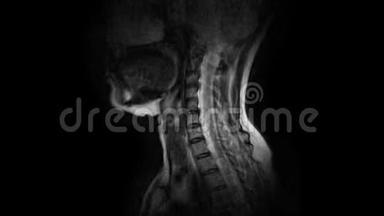 颈椎MRI的净化，突起和疝的检测