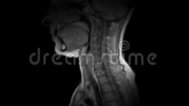 <strong>颈椎</strong>MRI的净化，突起和疝的检测