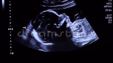 胎儿中期超声检查中20周龄婴儿面部及胸部轮廓