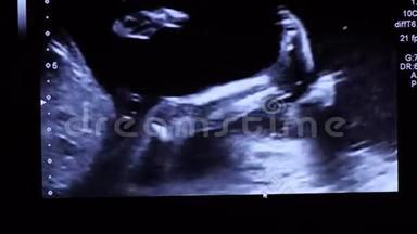 2d半超声检查中20周龄胎儿小腿脚运动