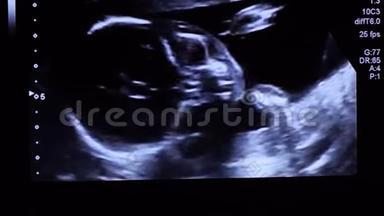 20周龄婴儿胎儿面部超声检查时直视屏幕