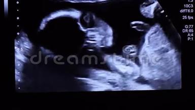 20周龄婴儿胎儿面部超声检查时直视屏幕