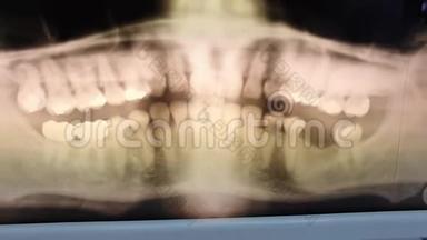 显示闪烁效果的中年男子全景牙科X射线照片