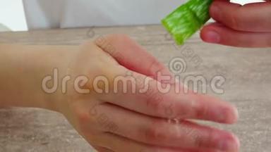 双手将芦荟胶涂在皮肤烧伤处。