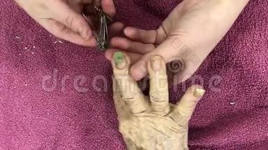 年轻照顾者用剪刀剪老年妇女的指甲。 癣或无骨癣，常见于老年人，