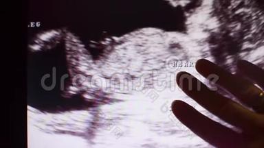 儿童胚胎超声扫描黑白照片