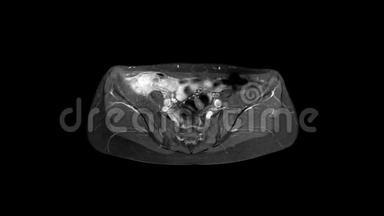 人体骨盆和臀部MRI扫描