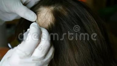 女人脱发。 医生或美容师<strong>做</strong>检查，<strong>做手术</strong>，头部的女人皮肤上没有头发。