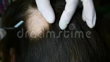 女人脱发。 医生或美容师做检查，做手术，头部的女人皮肤上没有头发。