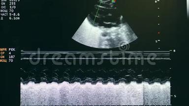 婴儿心脏的超声筛查。