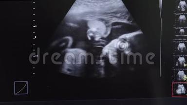 超声波监测屏幕显示母亲子宫中`婴儿