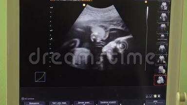 超声波监测屏幕显示母亲子宫中`婴儿