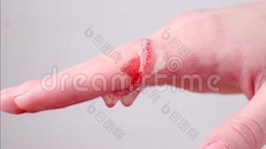 一个女人用消毒剂处理她手上的伤口