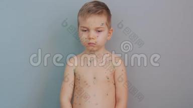 患有水痘的悲伤男孩。 生病的儿童水痘。