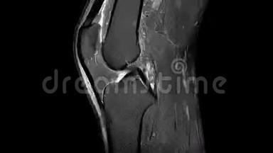 左膝韧带断裂的MRI扫描
