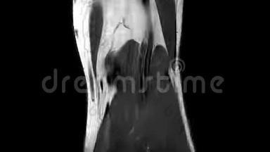 左膝韧带断裂的MRI扫描