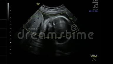 婴儿女孩在母亲子宫里平静地睡觉26周超声波扫描