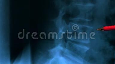 研究脊椎下腰部骨骼X线的医生