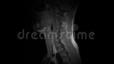 颈椎MRI扫描，脊柱突出和疝的检测