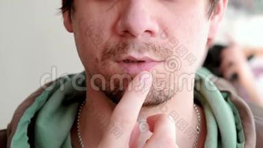 疱疹。 嘴唇治疗。 男人嘴唇`疱疹的特写。 男人把奶油放在嘴唇上。 前景。