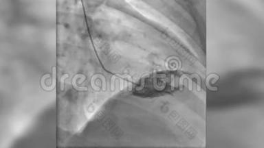 左心室灌注导管造影剂，心脏X线功能评估
