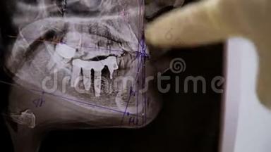 牙医展示了一个治疗牙齿横向x光的计划。 安装支架系统前的咨询