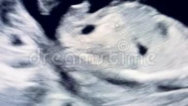 胎儿在母亲`子宫里是在做超声波检查时移动的