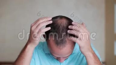 人类脱发或脱发-成年男子的手指向他的秃头