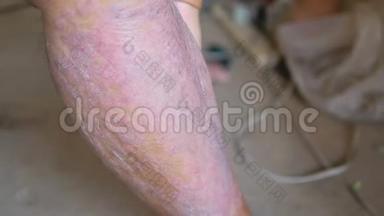 银屑病患者使用草药使用自己的腿与伤口。