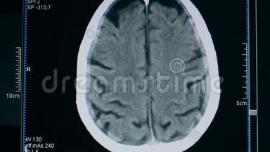 大脑检查的图像，关闭。 病人在诊所`<strong>脑部扫描</strong>。