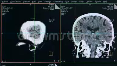 显示器上显示的脑部扫描过程