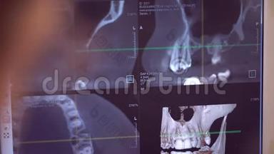 牙齿的X光全景<strong>图片</strong>和<strong>牙医</strong>`用工具的手在屏幕上移动
