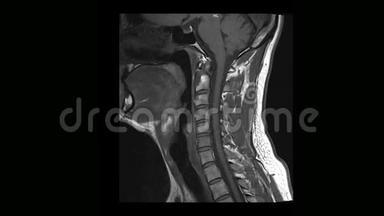 骨软骨病患者颈椎MRI计算机断层扫描