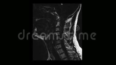 骨软骨病患者颈椎MRI计算机断层扫描