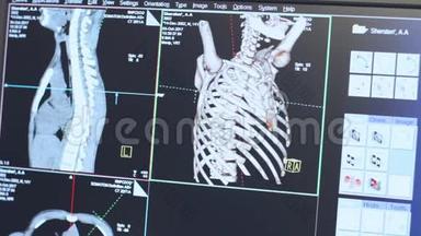 监视器上人体肋骨的断层扫描。 高技术<strong>放射线</strong>