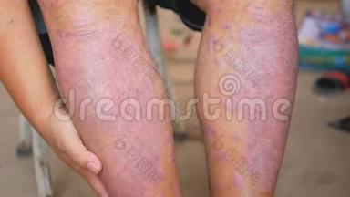 银屑病患者使用草药用自己的腿伤