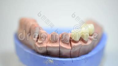 牙科技师在实验室为种植牙制作3D打印模具