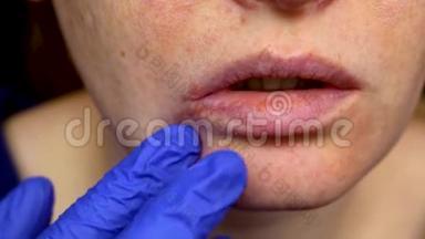 唇部疱疹：一名患感冒和疱疹病毒的妇女接受皮肤科医生和传染病专家的检查